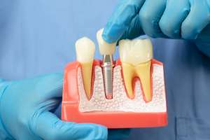 Teeth Implants Explained: Your Guide to a Stable Smile Teeth Implants Explained: Your Guide to a Stable Smile